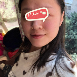 在北京玉之光整形医院下颌角磨骨改脸型案例 我也拥有了上镜小V脸