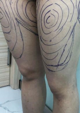 长腿女神 深圳广和整形专家柳松青吸脂瘦大腿案例分享