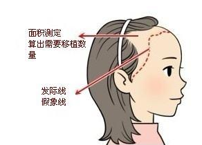 北京雍禾植发医院种植发际线效果怎么样 能维持多久