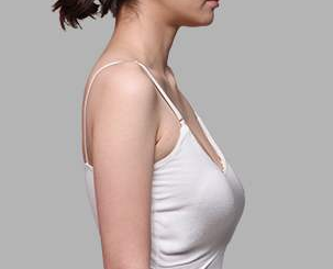 乳房下垂治疗 郑州艾伯丽整形医院乳房下垂矫正有方法