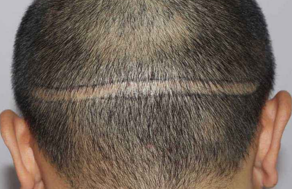 合肥华美植发整形医院在线咨询 疤痕植发多久能长出来