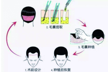 广州乐鬓毛发移植专家计斌头顶加密效果好吗 从头开始