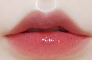 西安美莱整形李国玲做玻尿酸丰唇有哪些优势 多久能恢复