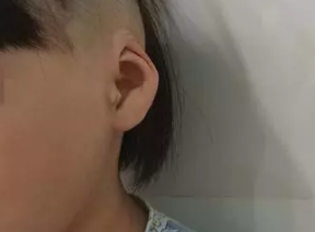 先天小耳畸形 锦州斯美诺整形医院小耳畸形矫正安全性如何