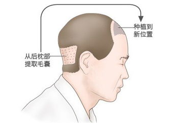 天津发际线种植哪里好 雍禾植发无痛移植重塑面部轮廓