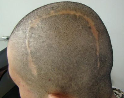 什么样的疤痕不适合植发 南宁科发源植发医院疤痕植发多少钱