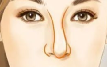 歪鼻矫正是怎么做的 广州美恩整形许扬滨三维分析 精细雕琢