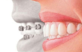 月经期可以做牙齿矫正吗 东莞韩美口腔医院为笑容加分