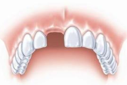 缺牙患者种植牙需知 广州紫馨整形医院张程种植牙贵吗