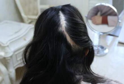 头上有疤痕多久可以植发 成都润禾植发怎么样