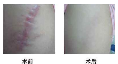 重庆艺星整形医院激光祛疤多少钱一次 赵蓉平复疤痕塑美肌