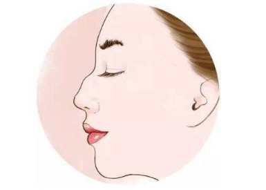 驼峰鼻矫正一般多久恢复 重庆铂生整形杜亚旭让您拥有直线美鼻