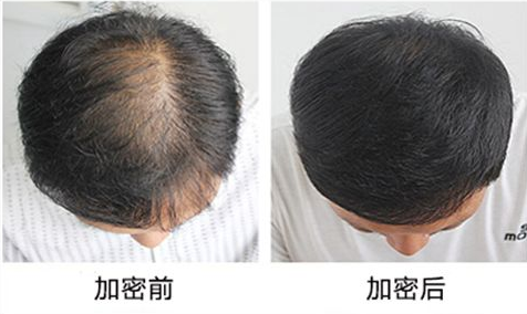 脱发头发少怎么办 杭州杭城植发整形医院加密植发靠谱吗