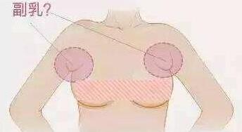 副乳会影响健康吗 切除法去副乳效果