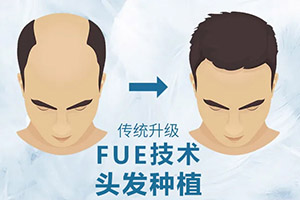 不做光头强 上海植信FUE国际植发医院头顶植发效果