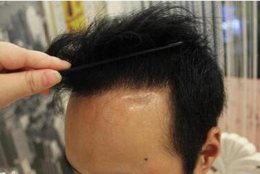植发手术选择什么时候比较好 种植头发大概要多少钱