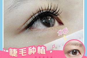 温州雍禾植发医院睫毛种植会正常生长吗 能用刷子刷吗
