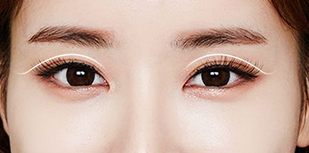 北京艺星整形医院双眼皮修复《精准修复 技术过硬》国内知名