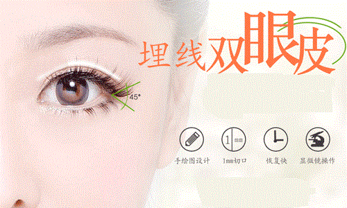 北京焕星整形医院埋线双眼皮 双眼皮成功案例对比图
