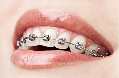 宿迁口腔医院做牙齿矫正多少钱 改善牙齿歪斜