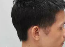 重庆欧亚植发医院鬓角种植 摆脱难看的秃鬓角