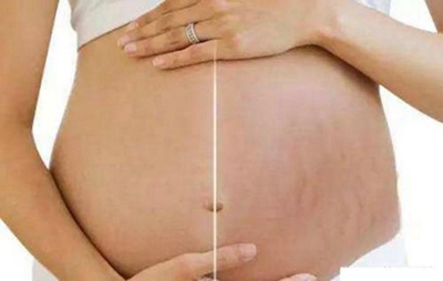 沧州京顺整形激光祛妊娠纹效果如何 价格是多少