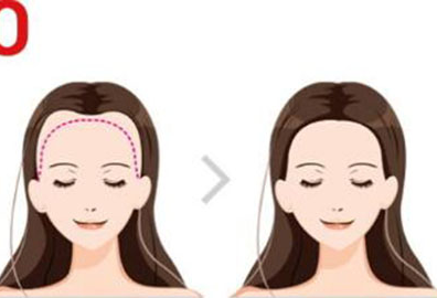 发际线种植后多久才能恢复 杭州雍禾植发挽救发际线 重塑脸型