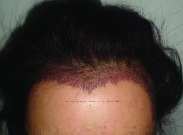 北京新生发植发医院种植发际线效果怎么样 会不会很痛