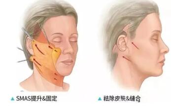 武汉艺星拉皮手术全能 做面部大拉皮同时还能解决颈部皮肤松弛下垂