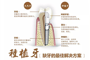 广州口腔专科医院推荐 广州广大口腔项目全面 种植牙性价比高