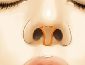 郑州韩式整形医院哪里好 有好的鼻整形专家吗 鼻小柱延长效果怎么样