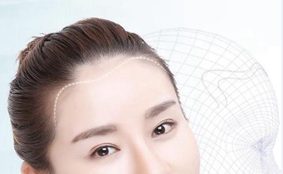 上海植发医院哪个好 种发际线费用是多少 轻松解决秃额头