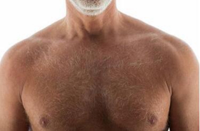 哈尔滨哪家医院植发好 胸毛种植大概多少钱 种出男性魅力