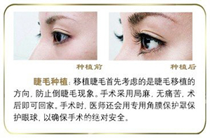 广州睫毛种植 新生植发信誉较好 大眼睛需长睫毛衬托