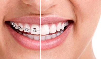 南京牙齿整形哪家好 牙齿地包天矫正要多少钱 需要多久