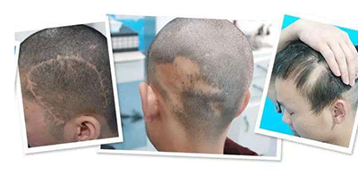 厦门新生植发医院疤痕植发多少钱 掩盖疤痕新发再生
