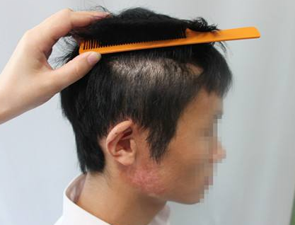 重庆时光毛发移植医院疤痕种植效果怎么样 贵吗