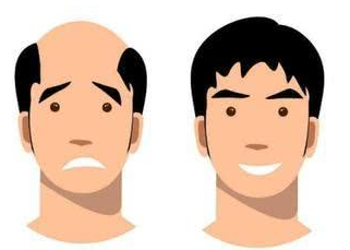 武汉头发种植多少钱 美基元植发医院正规 避免秃头形象