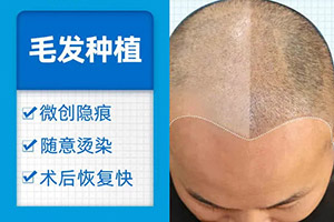杭州头发加密多少钱 时光毛发移植医院口碑 有副作用吗