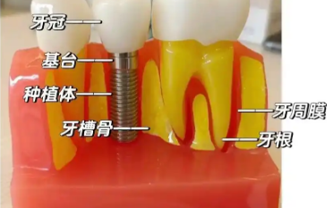 宁波恒美口腔门诊部种植牙多少钱?价格实惠技术好